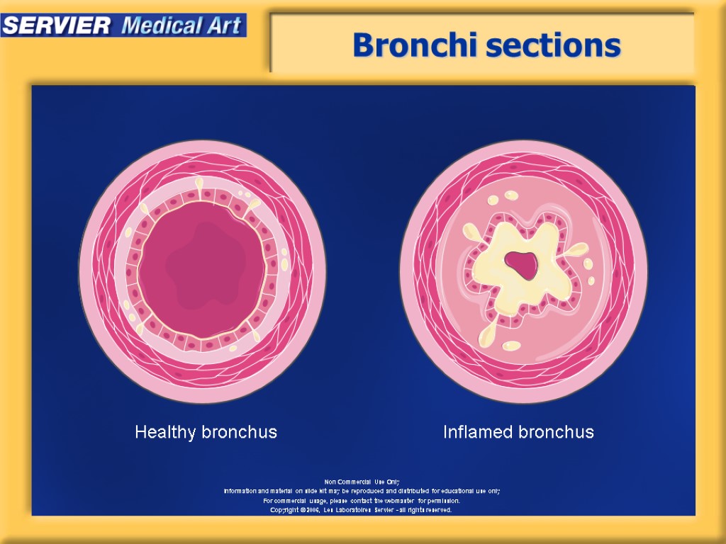 Bronchi sections Healthy bronchus Inflamed bronchus